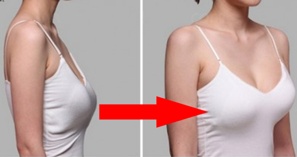 Augmentation mammaire avec implants en forme de goutte en mammoplastie. Photos avant et après