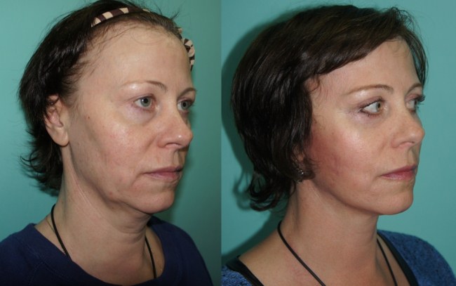 Hyaluronsäure-Injektionen für das Gesicht (Lippen, unter den Augen, Stirn). Vor und nach Fotos