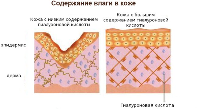 Ињекције хијалуронске киселине за лице (усне, испод очију, чело). Пре и после фотографија