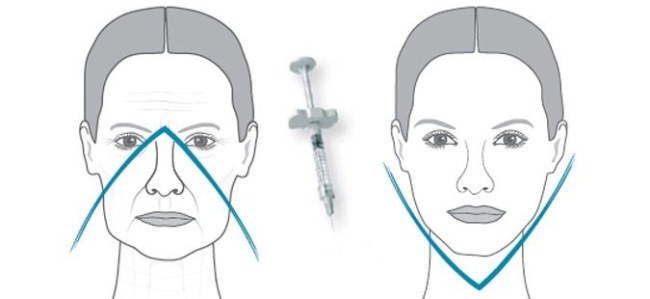 Suntikan asid hyaluronik untuk wajah (bibir, bawah mata, dahi). Foto sebelum dan selepas