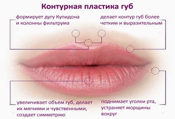Injekcije hijaluronske kiseline za lice (usne, ispod očiju, čelo). Fotografije prije i poslije