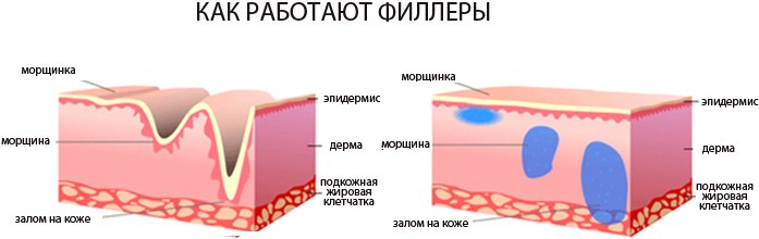 Hyaluronsyreinjeksjoner i ansiktet (lepper, under øynene, pannen). Før og etter bilder