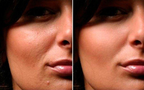 Mesoteràpia facial: què és? Fotos abans i després, ressenyes, a quina edat