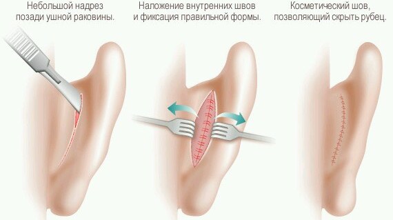 Pembedahan plastik pada telinga supaya tidak melekat. Harga, gambar, video