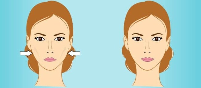 Radiesse i kindbenen. Bilder före och efter proceduren, pris, recensioner av kosmetologer