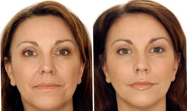 Radiesse i kindbenen. Bilder före och efter proceduren, pris, recensioner av kosmetologer