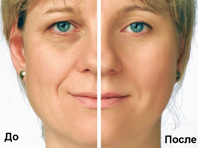 RF ansiktsløftning - hva er det, før og etter bilder, konsekvenser, legevurderinger