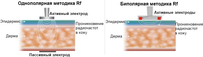 РФ лифтинг лица - шта је то, пре и после фотографија, последице, прегледи лекара