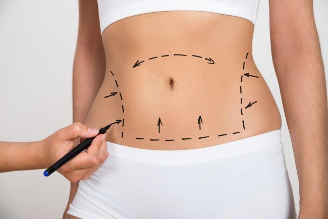 Liposuction badan. Berapa, harga, sebelum dan selepas foto, video, ulasan