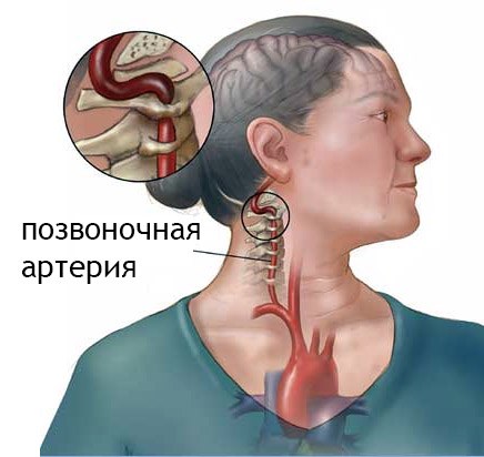 Övningar av Dr Shishonin i nacken med osteokondros. Gymnastik komplex, video