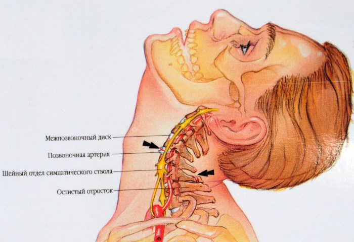 Latihan Dr Shishonin untuk leher dengan osteochondrosis. Kompleks gimnastik, video