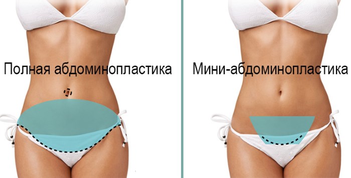 Abdominoplasty (tummy tuck). Apa itu, harga, sebelum dan selepas foto, video, ulasan
