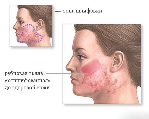 Peeling de diamantes para la piel del rostro. Qué es, indicaciones, aparato, precio del procedimiento, foto