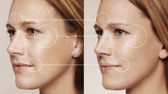 La biorivitalizzazione è una procedura di ringiovanimento del viso. Preparazioni, prezzo, recensioni, foto prima e dopo