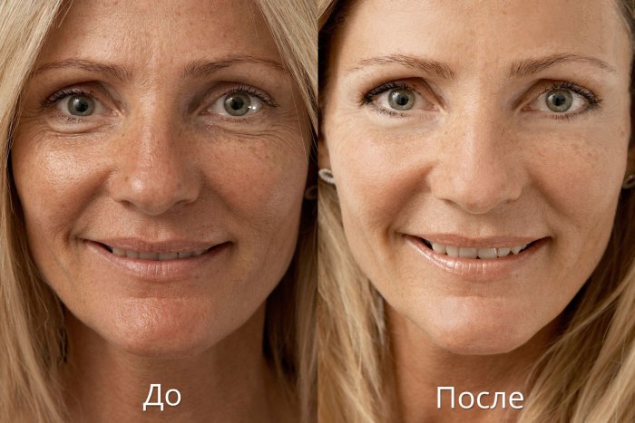 Biorevitalisering är ett ansiktsföryngringsförfarande. Förberedelser, pris, recensioner, före och efter foton