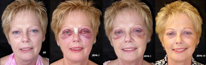 La bio-revitalisation est une procédure de rajeunissement du visage. Préparations, prix, avis, photos avant et après