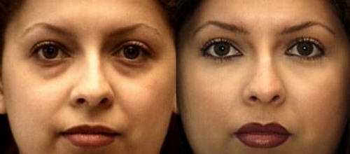 Cos'è il lipofilling? Lipofilling di viso, seno, glutei, prezzo, foto prima e dopo