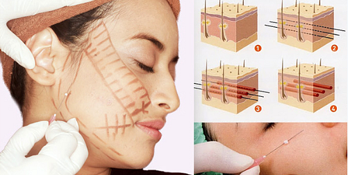 Ansiktsløftning for ansiktet - øvelser, kirurgi, ansiktsløftning