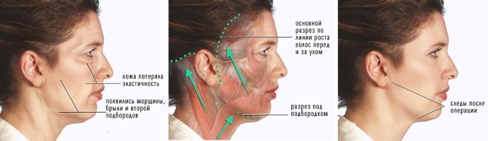 Ansiktsløftning for ansiktet - øvelser, kirurgi, ansiktsløftning