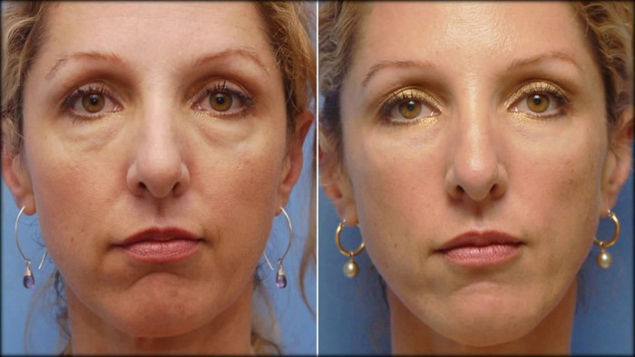 Facelift para o rosto - exercícios, cirurgia, lifting facial
