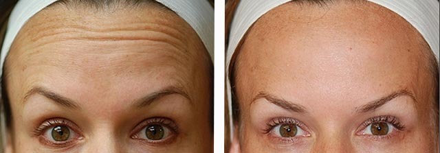 Dysport - what is it, the procedure, injections to the forehead, between the eyebrows from wrinkles. Results, photo