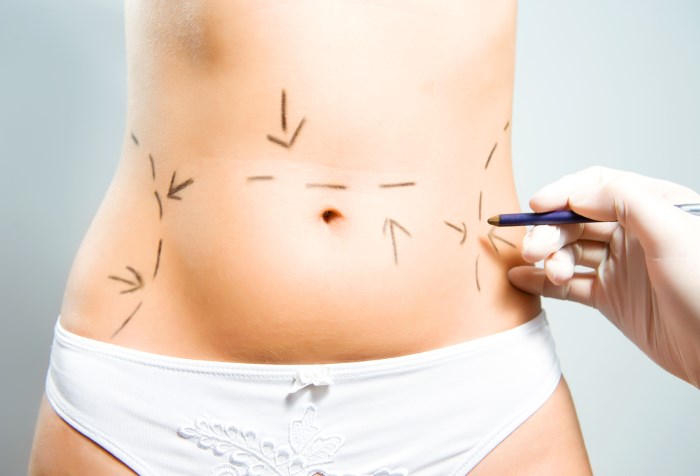 Com amagar les estries a l’estómac: mitjançant procediments, tatuatges, làser, foto