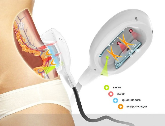 Cryolipolysis (cryoliposuction). What is it, price, reviews