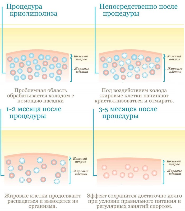 Cryolipolysis (cryoliposuction). Apa itu, harga, ulasan