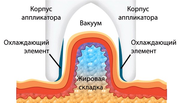 Cryolipolysis (kriyoliposuction). Nedir, fiyatı, yorumları