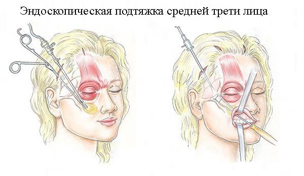 Gezichtsopheffing - wat is deze procedure. RF-tillen, gezichtsdraden, niet-chirurgisch tillen