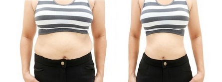 Liposucción del abdomen: tipos, fotos antes y después, revisiones.