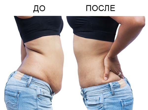 Liposuccion de l'abdomen - types, photos avant et après, avis