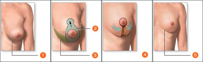 Mammoplastiek - plastische chirurgie van de borstklieren.Foto's voor en na, kosten, recensies