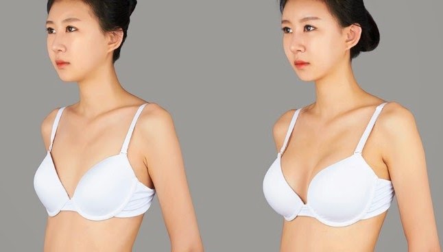 Mammoplastica - chirurgia plastica delle ghiandole mammarie. Foto prima e dopo, costi, recensioni