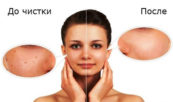 Mechaniczne czyszczenie twarzy: ultradźwiękowe, ręczne, sprzętowe
