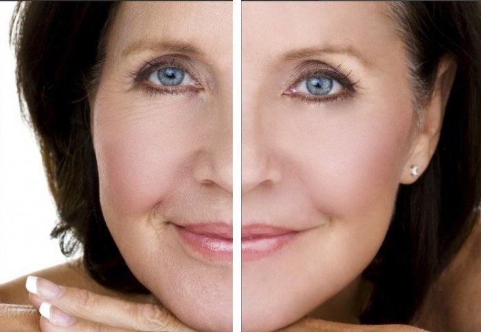 Mesothreads - mengangkat facelift dalam kosmetologi. Foto, ulasan, harga
