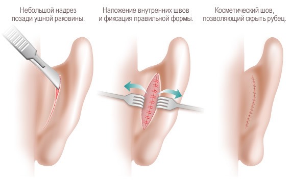 كيف تتم عملية تجميل الأذن؟