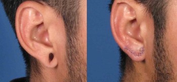 Otoplasty after tunnels
