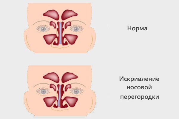 Septoplastia. Qué es, cirugía de tabique nasal, láser, indicaciones