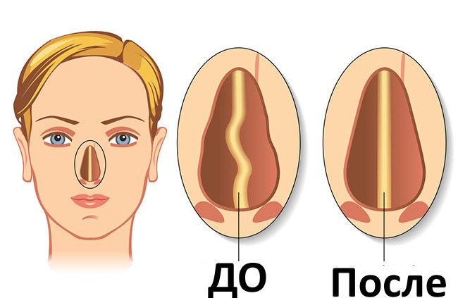 Septoplasti. Apa itu, pembedahan septum hidung, laser, petunjuk