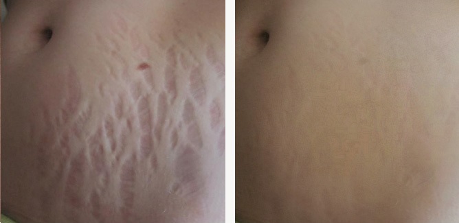 Hoe striae op de maag te verbergen: met behulp van procedures, tatoeages, laser, foto
