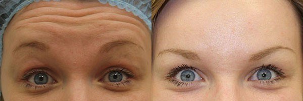 Botox injekciók a homlokán. Eredmények, fotók előtt és után, következmények, vélemények
