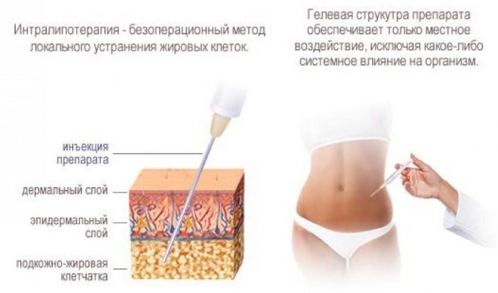 Injeccions d’aprimament a l’estómac. Injeccions d'ozó, lipolítics, Aqualix, comentaris, preus