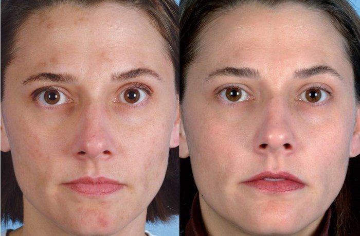 Ultralyd ansiktsrengjøring. Hva er det, hvordan peeling utføres, et apparat til hjemmet, bilder før og etter