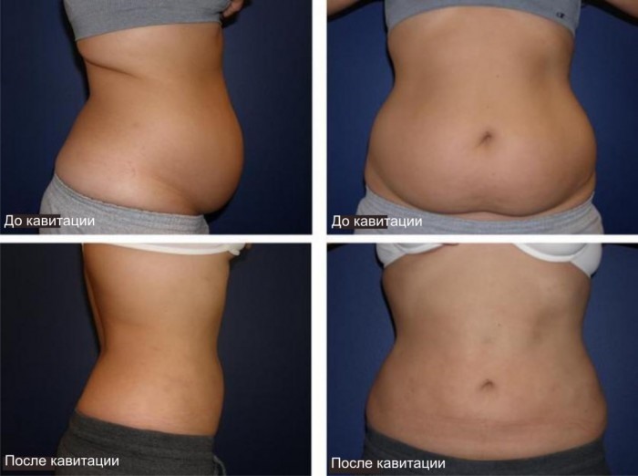 Cavitação - o que é, como a gordura é removida. Fotos antes e depois