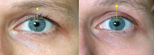 Non-surgical eyelid lift. Exercises, creams, Zhdanov lifting, skin lifting, mask at home. Reviews