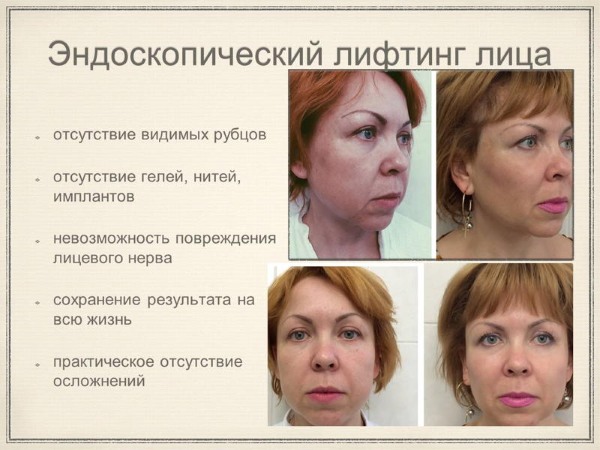Niet-chirurgische ooglidlift. Oefeningen, crèmes, Zhdanov-lifting, huidlift, masker thuis. Beoordelingen