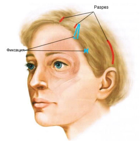 ¿Qué es un estiramiento facial endoscópico?