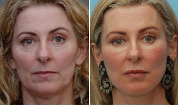 What is an endoscopic facelift