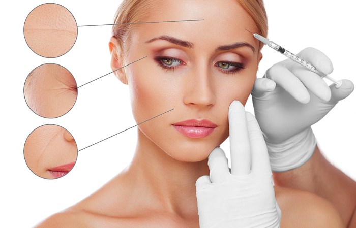 What are fillers in cosmetology